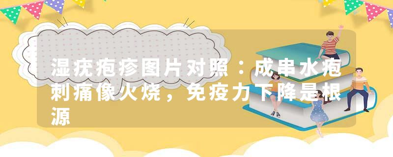 湿疣疱疹图片对照：成串水疱刺痛像火烧，免疫力下降是根源